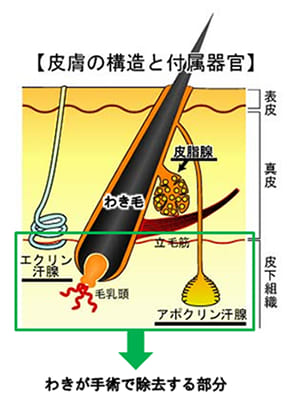 わきが（腋臭症）の手術（治療）方法｜わきが（腋臭症）保険診療・大阪駅徒歩5分