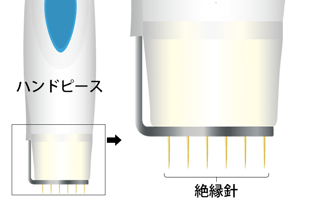 ビューホット治療のしくみ