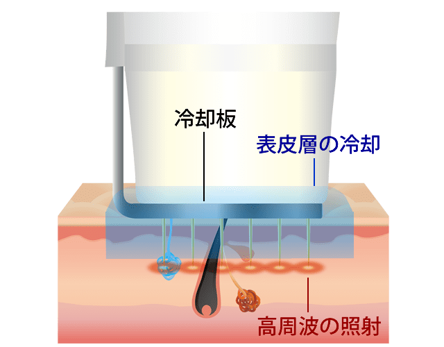ビューホット治療のしくみ